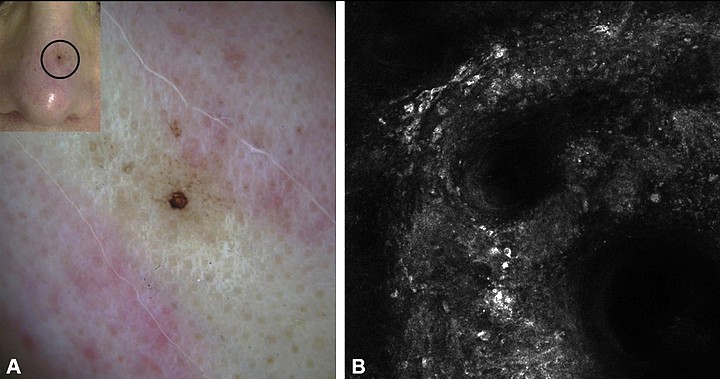 Scan of melanoma on nose