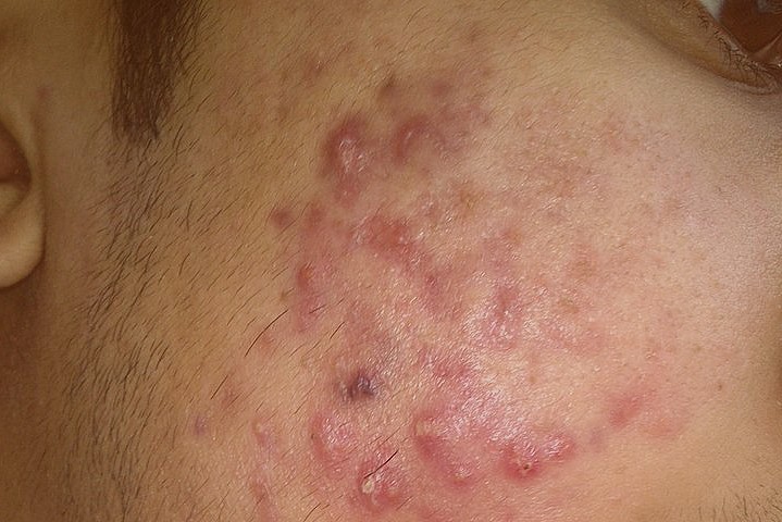 Acne on a patient with Asian skin