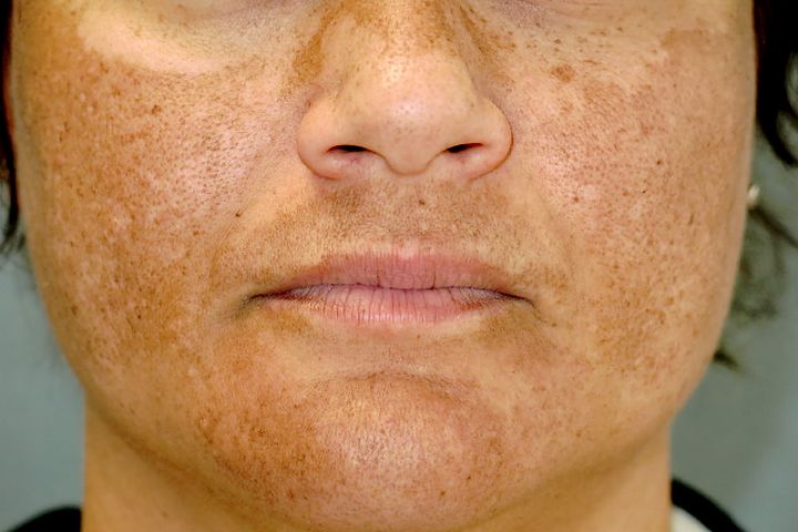 Melasma And Hyperpigmentation Treatment In London Skin Care Network