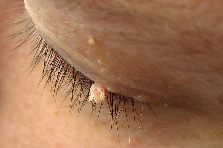 Tag extending from eyelid