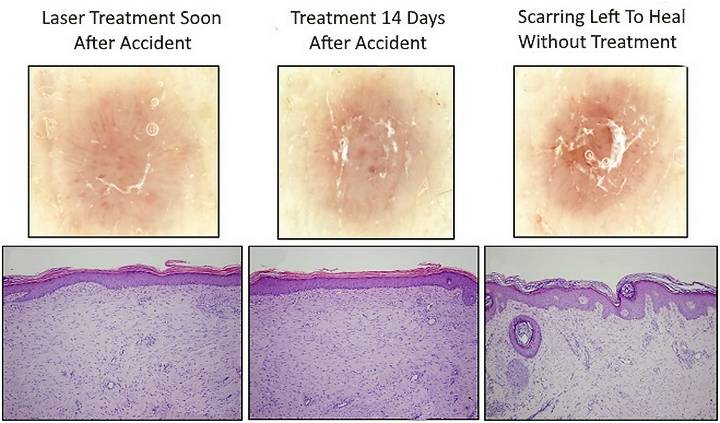 Early stage laser scar treatment