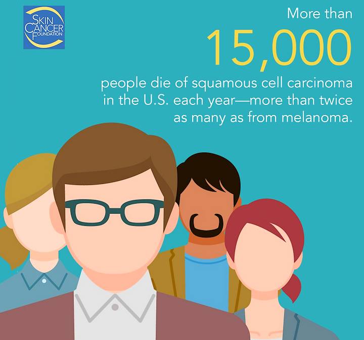 Number of deaths from squamous cell carcinoma