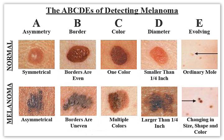 Guide to moles and melanoma