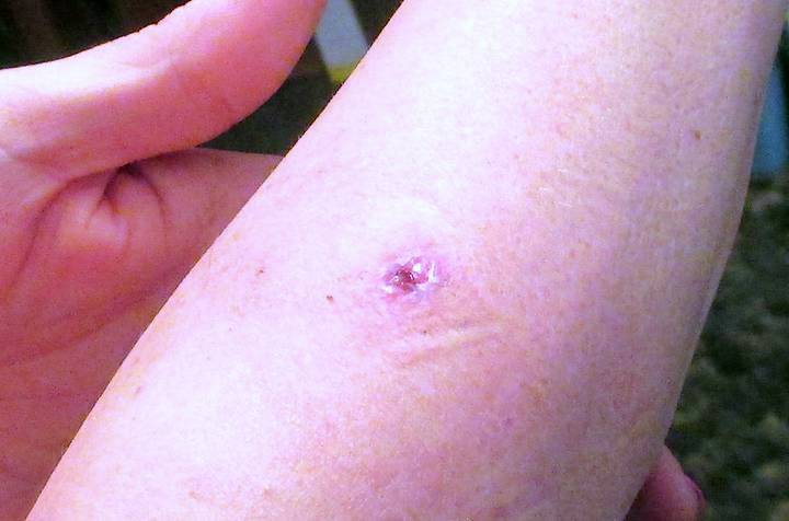 Scar caused by poor dermatology