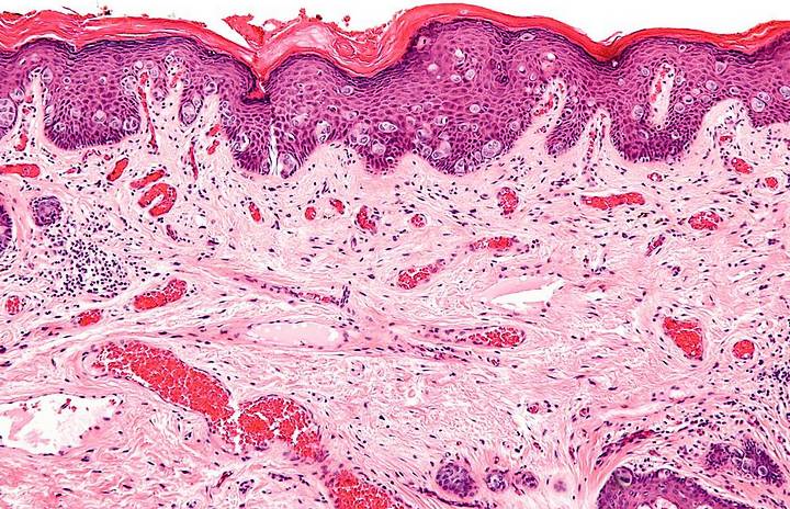 Biopsy showing EMPD cells