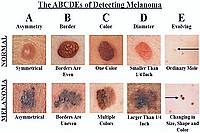 The signs of melanoma