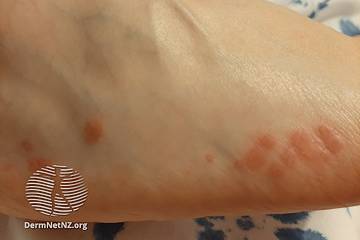 Covid skin condition on arm