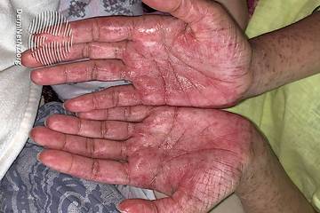 Palms of hands with rash