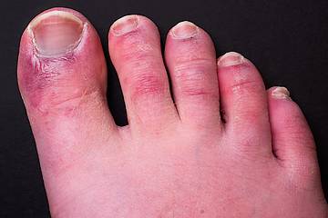 Typical example of Covid toe