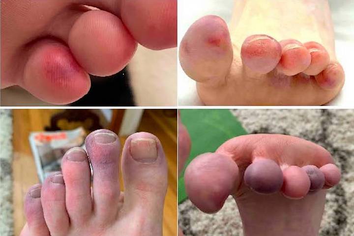 Examples of Covid toe
