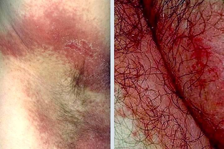 Heat Rash or Prickly Heat (Miliaria Rubra) Condition, Treatments