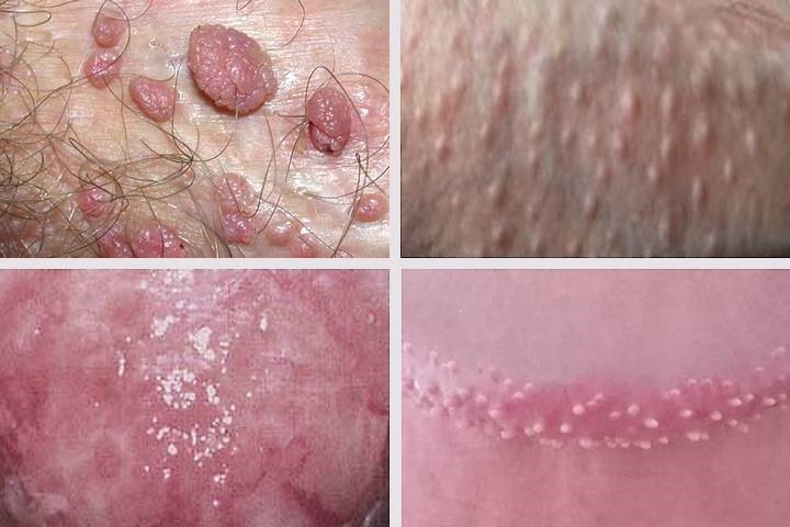 On treatment shaft papules penile The Causes