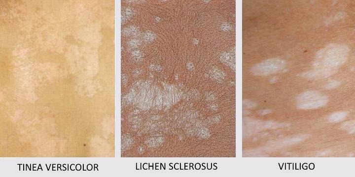 Comparison of conditions to vitiligo