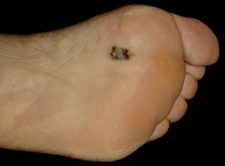 Lesion on sole of foot