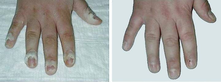 Viral warts on hand