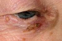 Wart on eyelid