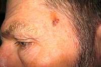 Skin cancer lesion on forehead