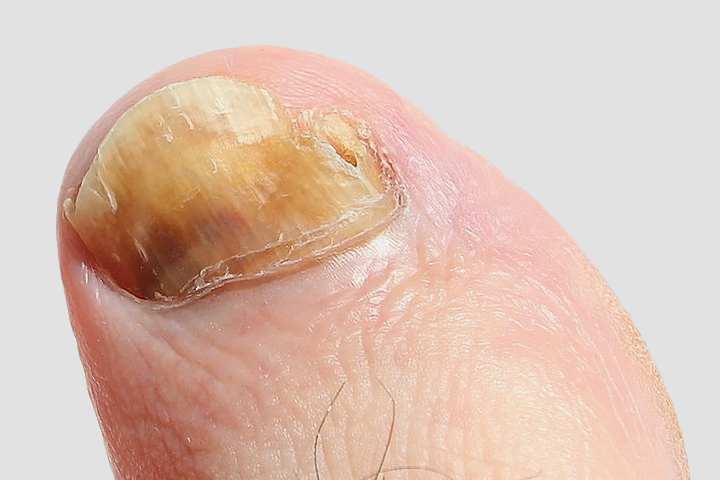 Fungal infection on toenail