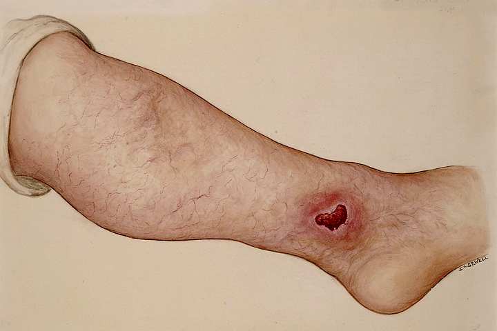 Ulcer and prominent veins on leg