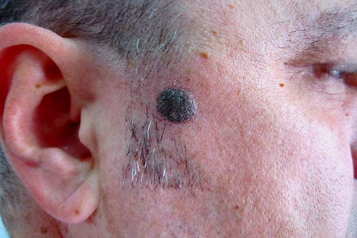 Wart on cheek near eye