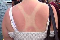 Sunburn on back