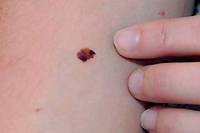 Cancer growing on arm
