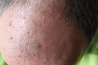 Could the HPV vaccine revolutionise Actinic Keratosis treatment? Discover emerging research and its potential impact on skin health.