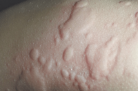 Personalised Treatment for Hidradenitis Suppurativa