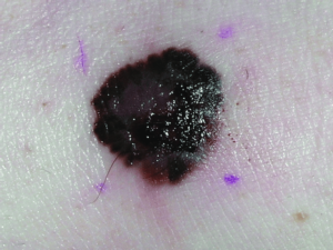 Skin Cancer Risk in Patients with Lymphoma and Leukaemia: Why Early Detection Matters