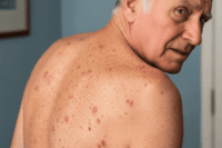 Itchy rash on your chest or back The SkinCare Network in London shares expert advice on Grover’s Disease, its symptoms, and treatments.