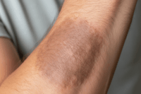 Learn about lichen simplex chronicus symptoms, causes, and effective UK treatments. Discover expert tips to manage chronic itching in London.