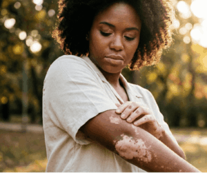 Improving Vitiligo Outcomes for Patients with Skin of Colour