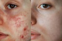 Discover how energy-based devices and tailored skincare reduce acne, scarring, and pigmentation for effective UK treatment outcomes.